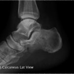 Fig. 5-B Figs. 5-A and 5-B: One year after surgery, anteroposterior (Fig. 5-A) and lateral (Fig. 5-B) radiographs of the right calcaneus revealed osseous erosion and destruction in the calcaneus. However, the gross structure was stable, and no osseous collapse had occurred.
