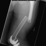 Fig. 2-A Preoperative radiograph of the left femur.
