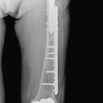 Fig. 2-B Postoperative anteroposterior radiograph of the left femur obtained after plate fixation with a 4.5-mm locking plate that was secured with multiple cables, locked screws proximally, and nonlocked screws distally.
