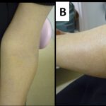 A 61-Year-Old Woman with Swelling of the Left Elbow