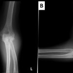 Fig. 2 Anteroposterior (Fig. 2-A) and lateral (Fig. 2-B) radiographs of the left elbow joint showing a soft-tissue tumor-like shadow.
