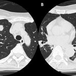 Fig. 4 Lung CT showing multiple nodules interpreted as probable tumors.

