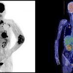 Fig. 5 Positron emission tomography scans showing multiple areas of uptake.
