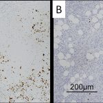 Fig. 7 Immunohistochemical staining for EBV-LMP (Fig. 7-A) and in situ hybridization for EBER (Fig. 7-B).
