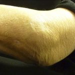 Fig. 8 Regression of swelling of the left elbow joint 1 year after stopping methotrexate therapy.
