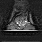 Fig. 1-B T2-weighted MRI demonstrating high signal. There is mild expansion of the posterior elements on the left, with a mass effect on the cord, causing mild effacement of the thecal sac. There is a honeycomb appearance of the vertebra (arrow).
