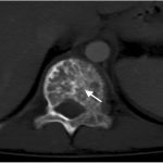 Fig. 2-B CT showing the lesion expanding into the pedicle and the posterior elements on the left. There is a polka-dot appearance of the axial spine (arrow).
