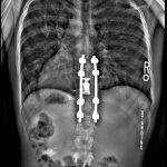 Fig. 5-A Standing anteroposterior spine radiograph at 12 months after surgery. The patient was asymptomatic and had no hardware complications.
