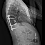 Fig. 5-B Standing lateral spine radiograph at 12 months after surgery. The patient was asymptomatic and had no hardware complications.
