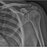 Fig. 1 Anteroposterior radiograph of the left shoulder demonstrates an ill-defined osteolytic lesion in the spine of the scapula.
