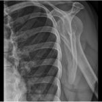 Fig. 2 Lateral radiograph (Y view) of the left shoulder demonstrates an ill-defined osteolytic lesion in the spine of the scapula.
