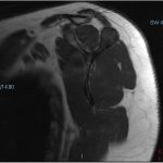 Fig. 4 Sagittal T1-weighted MRI of the scapula shows the spine of the scapular lesion with hypointense signal.
