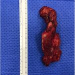 Fig. 8 Clinical photograph showing the excised specimen after the tridimensional partial scapulectomy.
