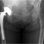 A 77-Year-Old Woman with a Clicking Right Hip
