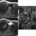 Fig. 2 Axial T1-weighted (Fig. 2-A) and T2-weighted (Fig. 2-B) MRI of the pelvis showing a large inhomogeneous mass in the right iliac fossa. Coronal T2-weighted (Fig. 2-C) imaging showed that the mass appeared to elongate anteriorly to the right hip joint.
