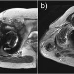 Fig. 3 Axial T2-weighted MRI images showing the trochanteric cystic lesion (Fig. 3-A) connected to the hip joint space (white arrow). Development of a similar horizontal demarcation line (black arrows) in both the trochanteric cystic lesion (Fig. 3-A) and the intrapelvic mass (Fig. 3-B) was also visualized.
