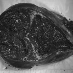 Fig. 5 The cystic mass had a thick fibrous wall.

