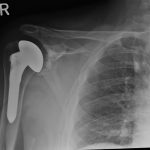 Fig. 1 Initial anteroposterior radiograph at the first postoperative visit demonstrating a well-placed humeral stem and glenoid component with no radiographic evidence of loosening.
