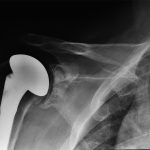 Fig. 2-A Anteroposterior radiograph of the shoulder three years postoperatively. The humeral stem remains in good position.
