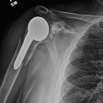 Fig. 3-A Anteroposterior radiograph of the right shoulder 9.5 years postoperatively, after the patient sustained a mechanical fall.
