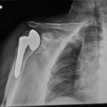 Fig. 3-B Grashey radiograph of the right shoulder 9.5 years postoperatively, after the patient sustained a mechanical fall.
