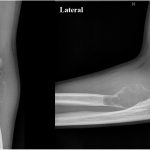 A 23-Year-Old Man with Persistent Elbow Pain