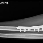 Fig. 4 Anteroposterior (AP, left) and lateral (right) radiographs taken 5 months after surgery showing interval healing with intact joint articulation and no signs of allograft or hardware failure.
