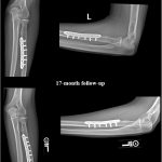 Fig. 5 Anteroposterior (AP, left) and lateral (right) radiographs taken 17 and 54 months after surgery showing full union with intact joint articulation and no signs of allograft or hardware failure.
