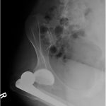 Fig. 1-A Cross-table lateral radiograph of the right hip demonstrating a posterior hip dislocation.
