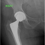 Fig. 1-B Radiograph showing a congruent right total hip component after reduction.
