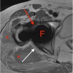Fig. 2-A Axial PD-MARS MRI demonstrating a located right femoral prosthetic head. The striated band with interspersed fatty tissue represents the sciatic nerve (white and red arrows). A hematoma (asterisks) is anterior to the gluteus maximus. F = femoral prosthetic head.
