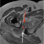 Fig. 2-B Axial PD-MARS MRI demonstrating a large hematoma interposed in the ischiofemoral space (asterisk); the sciatic nerve is identified (white and red arrows).
