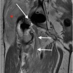 Fig. 2-C Coronal MRI with PD-MARS demonstrating the sciatic nerve (arrows). The soft-tissue hematoma is evident (asterisk).
