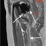 Fig. 2-D Sagittal MRI with PD-MARS demonstrating the sciatic nerve (arrows). The soft-tissue hematoma is evident (asterisk). GM = gluteus maximus.
