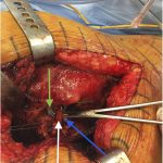 Fig. 3-A Intraoperative photograph. The sciatic nerve (white arrow) was coursing anterior to the femoral (blue arrow) and acetabular (green arrow) components in an abnormal anteroposterior trajectory.

