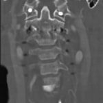 Fig. 1 Postoperative (April 2012) coronal CT image of the cervical spine depicting proper placement of the two C1 screws through the lateral mass of C1.
