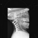 Fig. 2 Postoperative (April 2012) lateral cervical radiograph depicting proper placement of the posterior instrumentation from C1 to C7.

