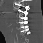 Fig. 3 Postoperative (April 2012) sagittal CT scan of the cervical spine depicting proper placement of the posterior instrumentation. Note the correct placement of the screw through the lateral mass of C1.
