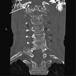 Fig. 4 Coronal CT scan of the cervical spine made two years postoperatively (March 2015) depicting the left C1 screw (arrow).
