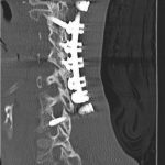 Fig. 5 Sagittal CT scan of the cervical spine made two years postoperatively (March 2015). depicting the left C1 screw.
