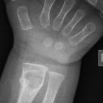 Fig. 1-A Posteroanterior radiograph of the right wrist demonstrating a large lytic (lucent) lesion with a nondisplaced pathologic fracture.

