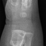 Fig. 1-B Lateral radiograph of the right wrist demonstrating a large lytic lesion with a nondisplaced pathologic fracture.
