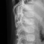 Fig. 2-A Lateral radiograph of the spine with evidence of lytic lesions in multiple vertebral bodies.
