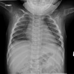 Fig. 2-B Anteroposterior radiograph of the chest and proximal portions of the upper extremities demonstrating lytic lesions in the proximal aspects of both humeri, multiple ribs, and multiple vertebral bodies.
