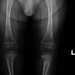 Fig. 2-C Anteroposterior radiograph of the lower extremities demonstrating lytic lesions in the proximal and distal aspects of both femora, the proximal and distal aspects of both tibiae, and the distal aspect of the right fibula.
