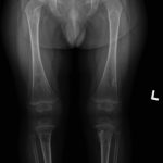 Fig. 4-A Repeat anteroposterior radiograph of the lower extremities 8 weeks after the initial radiographs made at presentation showing no new lesions and diminishing size of the right distal fibular lesion.
