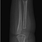 Fig. 4-B Repeat posteroanterior radiograph of the right upper extremity 8 weeks after initial presentation showing fracture-healing.
