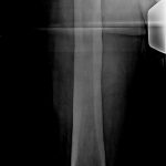 Fig. 2 Anteroposterior radiograph of the right femur showing diffuse thickening of the cortex, mostly evident in the diaphysis.
