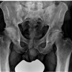 Fig. 3 Anteroposterior radiograph of the pelvis showing bilateral chronic femoral diaphyseal cortical thickening and sclerosis with severe degenerative changes of the right hip.

