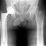 Fig. 4 Anteroposterior radiograph of the pelvis in the immediate postoperative period showing appropriate alignment and no evidence of hardware complication.
